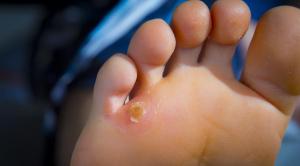 میخچه پا چیست؟