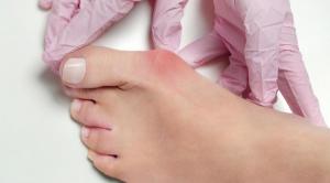 انحراف شست پا چیست؟