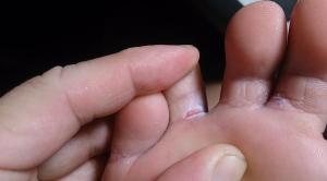 پای ورزشکار چیست؟